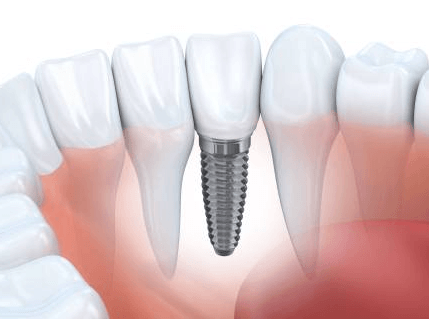Complete Dental offers dental implant services in Houston, TX